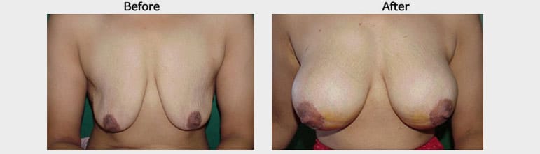 Breast augmentation case 3