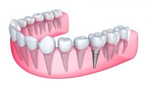 Dental Implants Hero section