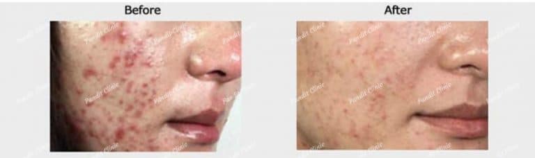 acne and acne scars results