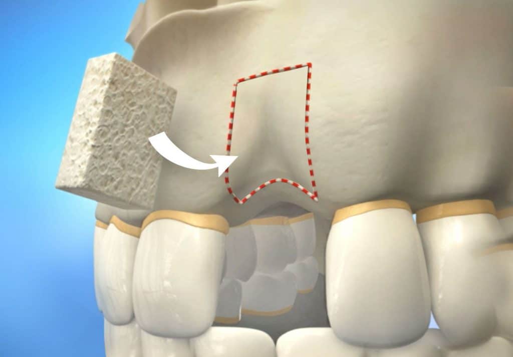 Alveolar bone grafting: overview of procedure