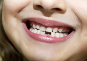 Space Maintainers for Children's Teeth | Pandit Clinic, Pune