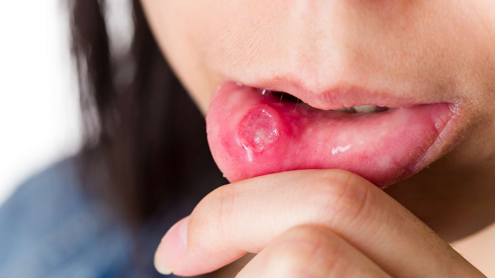 Read more about the article Oral Ulcers In Children: Causes And Treatment