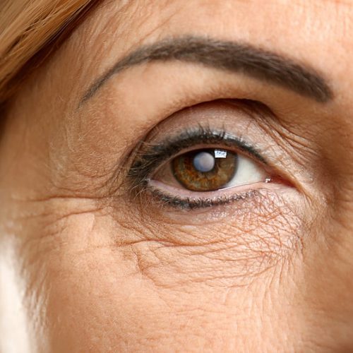 cataract cataract